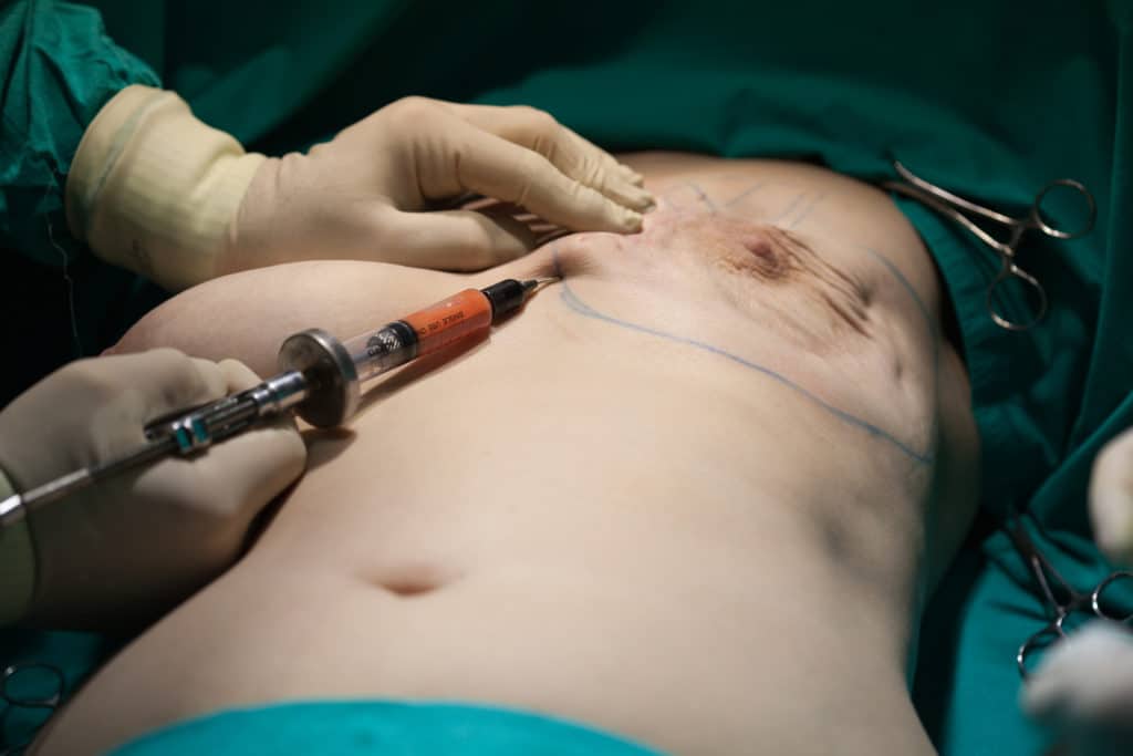A woman receiving a breast reconstruction due to breast cancer. A surgeon is filling breasts with her own fat after a mastectomy.