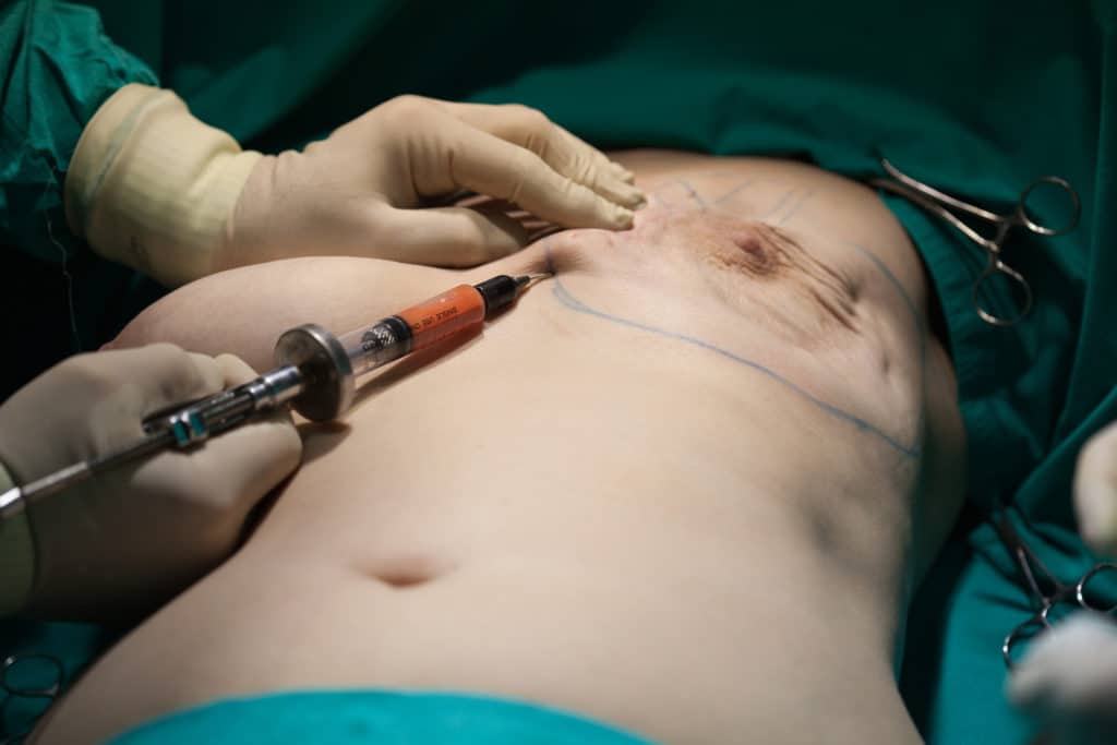 Breast Reconstruction Albany NY